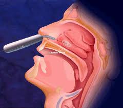 Ipertrofia turbinati laser costo